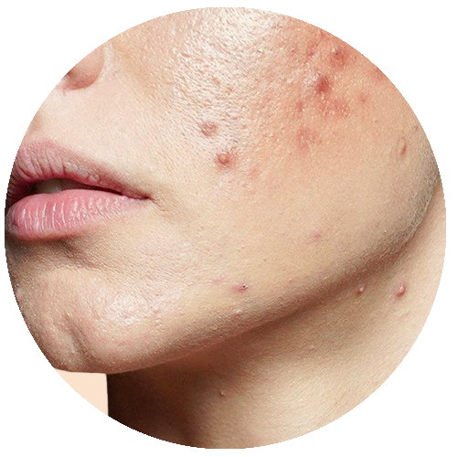 Acne