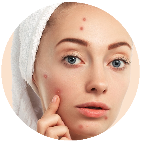 Pimples