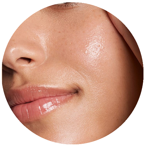 Excess sebum