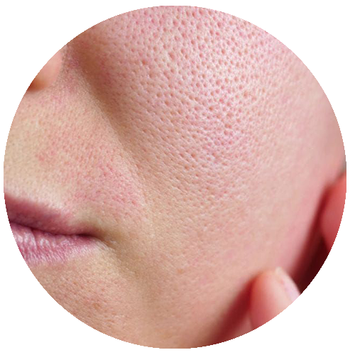 Clogged pores